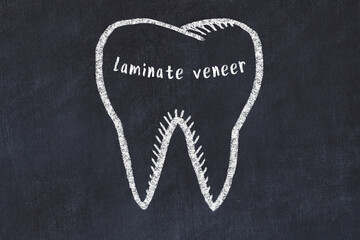 Wall Mural - Chalk drawing of a tooth with medical term laminate veneer. Concept of learning stomatology