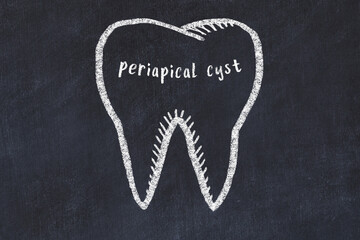 Wall Mural - Chalk drawing of a tooth with medical term periapical cyst. Concept of learning stomatology