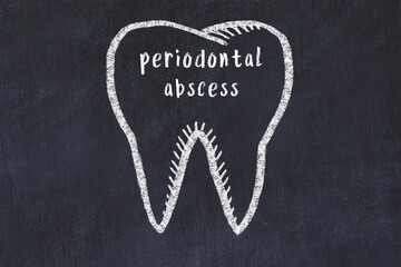 Wall Mural - Chalk drawing of a tooth with medical term periodontal abscess. Concept of learning stomatology