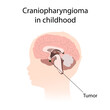 Craniopharyngioma in childhood. Brain cancer, tumor with explanations.