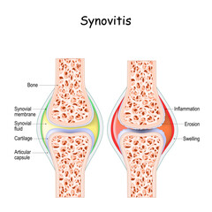 Poster - synovitis. Close-up