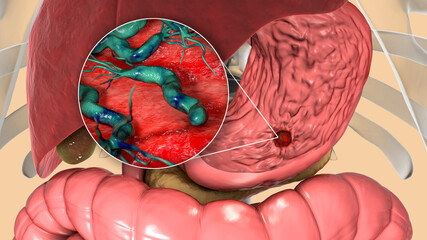 Poster - Peptic ulcer, stomach ulcer