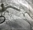 coronary angiogram shown massive thrombus that occluded left anterior descending artery (LAD) in patient with ST elevation myocardial infarction (STEMI) who undergoing open heart surgery.