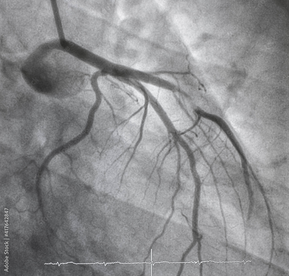 Coronary angiogram , medical x-ray for heart disease. Coronary artery ...