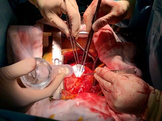 surgeon used dacron patch for closure of ventricular septal rupture (vsr) in acute myocardial infarc