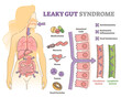 Leaky gut syndrome as immune system reaction to environment outline diagram