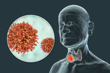 Poster - Thyroid cancer, tumor inside thyroid gland