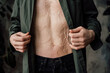 © Yakobchuk Olena - Man with scars at the skin after burn putting on green shirt