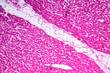 © Pansfun Images/Stocksy - Rheumatic endocarditis human cells micrograph