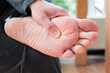 Foot with corns, calluses and dry skin, wart plantar verrucas. Verrucas papilloma callus virus, disease on foot skin. Unhealthy foot leg with corn close up. Man shows callosity before treatment