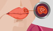 © grafixme - Herpes simplex virus on lip close up illustration
