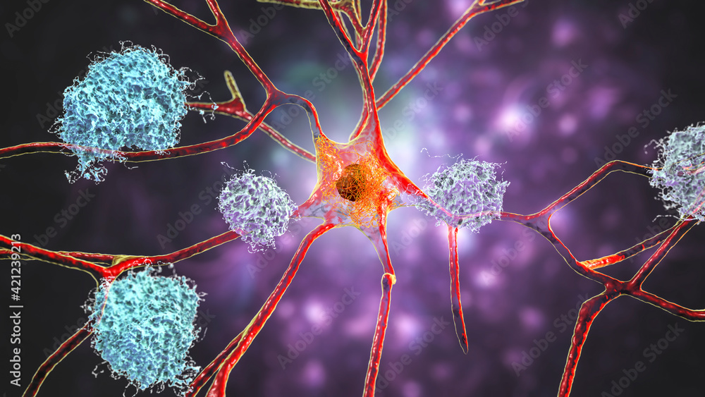 Neurons in Alzheimer's disease. Illustration showing amyloid plaques in brain tissue - obrazy, fototapety, plakaty 