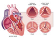 Medical illustration shows the difference between a normal aortic valve and one with stenosis, open and closed, and its location in the heart, with annotations.