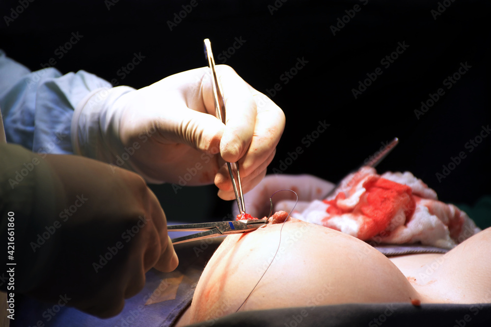 Sutura de implante mamario. Sutura de aureola. Mamoplastia. Cirugía de implantes de senos. - obrazy, fototapety, plakaty 