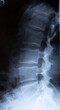 Röntgenbild, Röntgenaufnahme  von Wirbelsäule /Rücken.