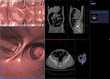 © samunella - CT colonography or CT Scan of Colon axial view vs Coronal view and 3D rendering image