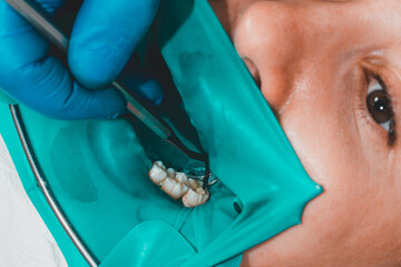 treatment of a chewing tooth, the dentist put a rubber dam, uses sterile tools, uses modern technology.