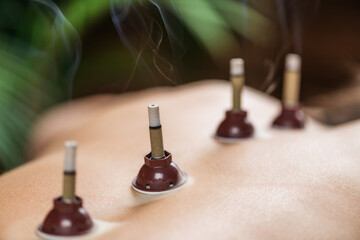 Wall Mural - Mugwort moxibustion Back Therapy