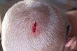 Injury to the scalp. Blood escapes from a chopped head wound due to falling metal reinforcement. Failure to comply with safety techniques