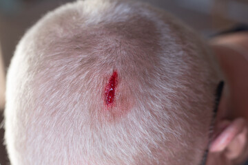 Injury to the scalp. Blood escapes from a chopped head wound due to falling metal reinforcement. Failure to comply with safety techniques