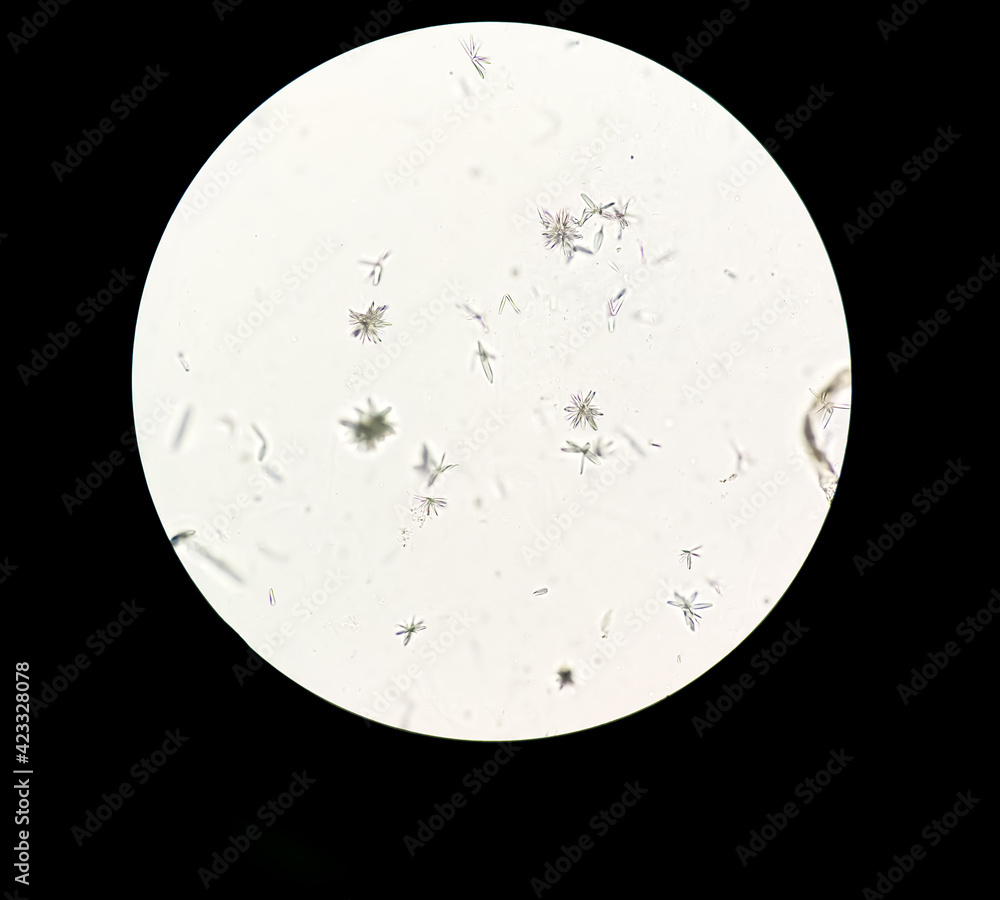 Urine microscopic examination under 40X light microscope with Tyrosine ...