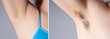 © staras - Before after underarm hair removal, female hairy armpit, clean skin after shaving