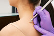 © Peakstock - Close up dermatologist removing a mole on a woman's back using a laser knife. Painless removal of benign skin lesions at medical center