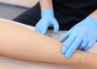 © lial88 - Doctor examines varicose veins on a woman's legs