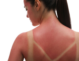 Poster - Woman with sunburned skin on white background, closeup