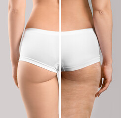 Canvas Print - Young woman before and after anti-cellulite treatment on grey background