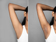 Asian woman with underarm before and after skincare cosmetology armpits epilation treatment concept.  black armpit in a woman.