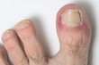 Infection of the toenail of a person's big toe. Close up.