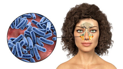 Wall Mural - Inflammation of maxillary sinuses in a woman and close-up view of bacteria that cause sinusitis