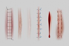 Surgical Sutures. Medical Closeup Stitches Scars And Wounds Decent Vector Realistic Illustrations