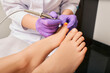 © Peakstock - Treatment fungal infection on woman's toenail with podologist using a medical laser. Fungal infection on the human toenails