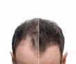 canvas print picture - Vorher Nachher - Halbglatze eines Mannes mit Haarausfall	von vorne
