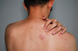 © sakaj - Close up view of man scratching his back .Painful back skin rash with blisters in a limited area.A man who having varicella blister ,  chickenpox,Herpes zoster or Shingles.
