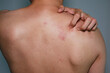 © sakaj - Close up view of man scratching his back .Painful back skin rash with blisters in a limited area.A man who having varicella blister ,  chickenpox,Herpes zoster or Shingles.