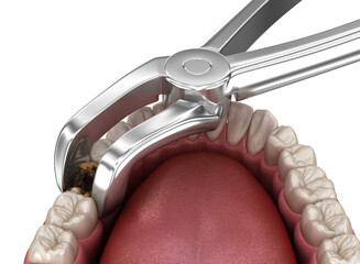 Extraction of Molar tooth damaged by caries. Medically accurate tooth 3D illustration.