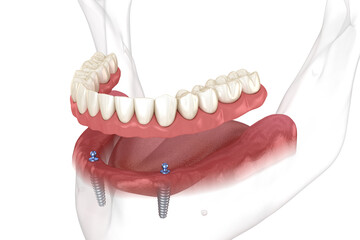 Mandibular removable prosthesis All on 2 system supported by implants with ball attachments. Medically accurate dental 3D illustration