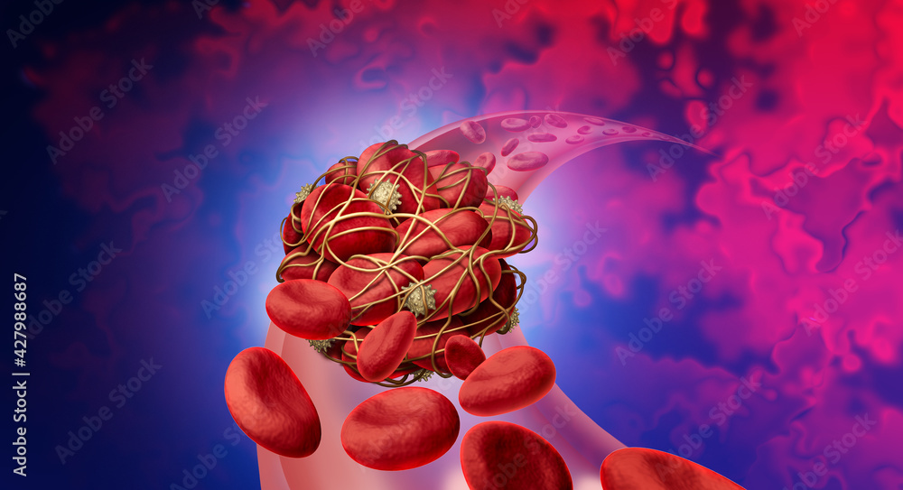Blood clot health risk or thrombosis medical illustration concept symbol as a group of human blood cells clumped together by sticky platelets and fibrin as a blockage in an artery or vein - obrazy, fototapety, plakaty 