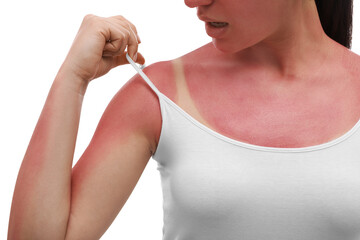 Wall Mural - Woman with sunburned skin on white background, closeup