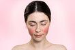 © _KUBE_ - Portrait of a beautiful woman with her eyes closed, showing inflamed blood vessels on her cheeks. Pink background. Copy space. Rosacea treatment concept