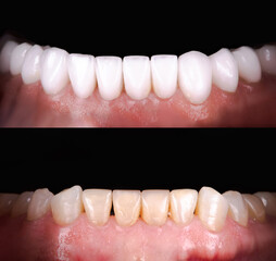 Wall Mural - Perfect smile before and after veneers bleach of zircon arch ceramic prothesis Implants crowns. Dental restoration treatment clinic patient. Result of oral surgery procedure whitening dentistry