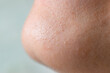 Macro close up in selective focus of a chin with large amount of blackheads and dilated pores. Blemishes of oily and combination skin. Rough face skin with blackheads in relief.