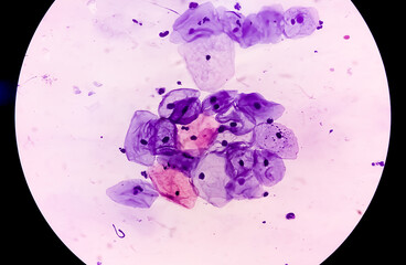 Sticker - Microscopic view of human cervix cells. Squamous epithelial cells. Pap smear. pap's. Squamous cell carcinoma (SCC)