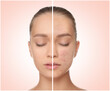 © New Africa - Young woman with acne problem before and after treatment on light background, collage