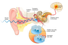 Tinnitus. Damaged Hair Cells Inside Cochlea