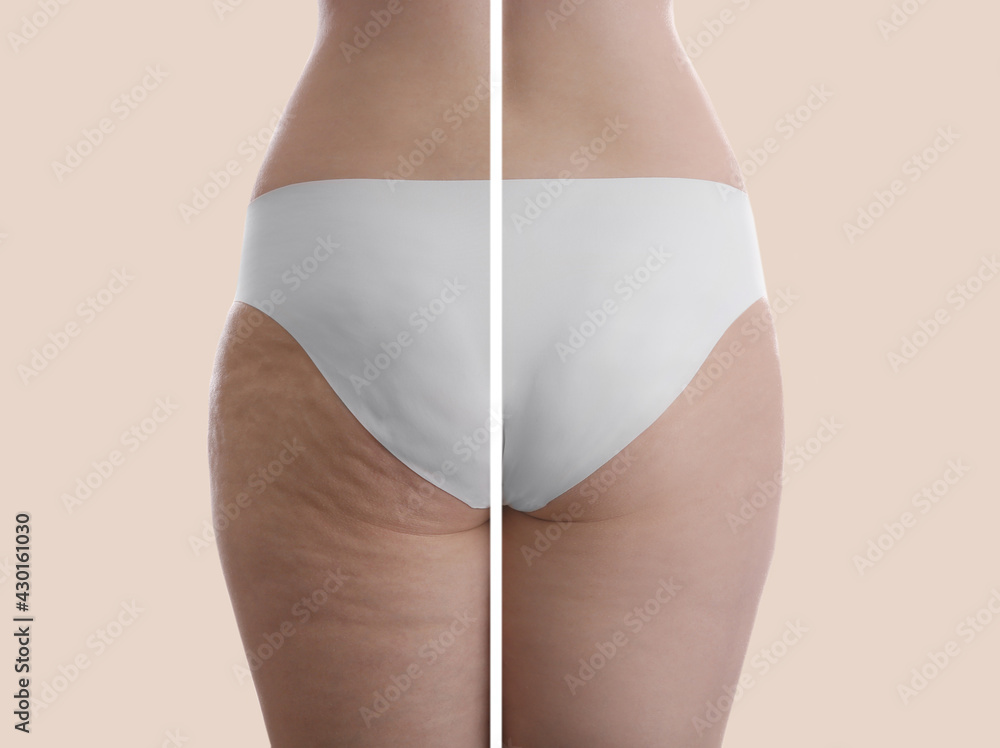 Collage with photos of woman before and after anti cellulite treatment on beige background, - obrazy, fototapety, plakaty 