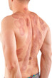 © Eskymaks - Suction cup marks on man's back.